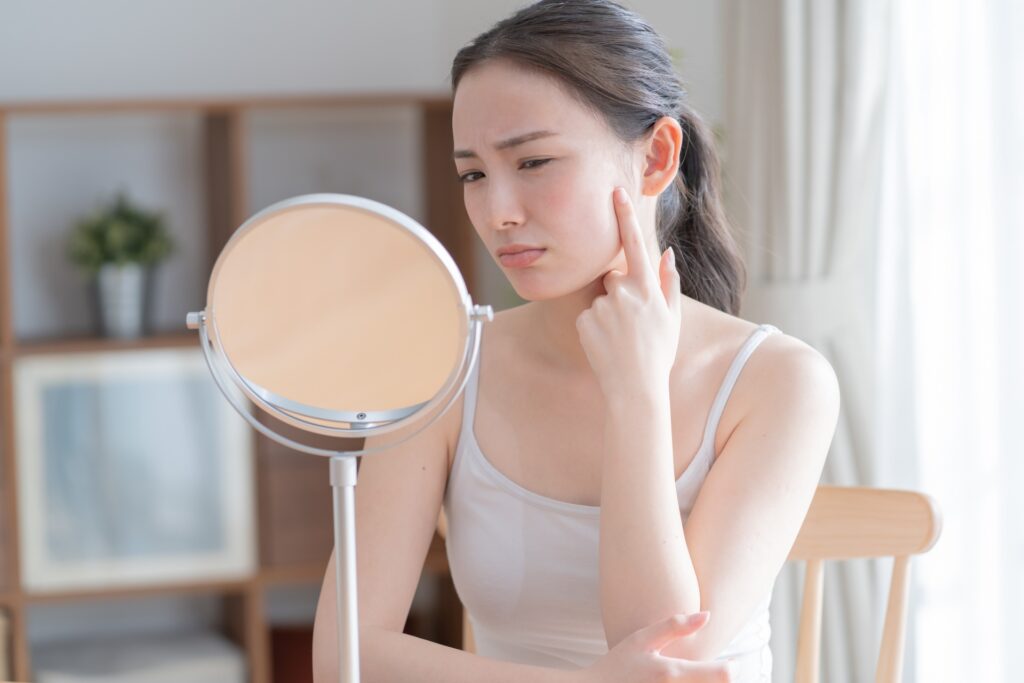 ニキビ・ニキビ跡