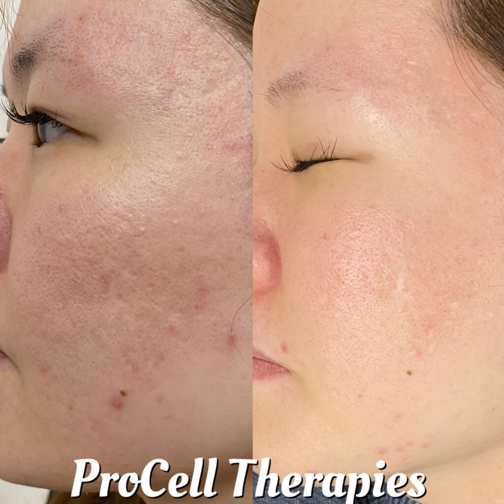 プロセルセラピーズ  施術事例