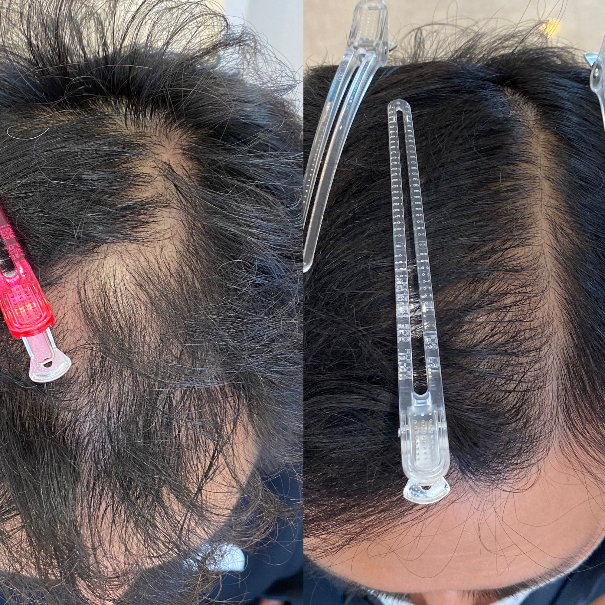 頭皮環境が改善され、髪の毛一本一本の存在感が増してきました