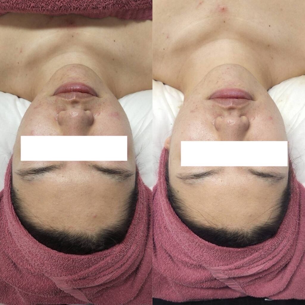 ハーブオフトリートメント 施術事例