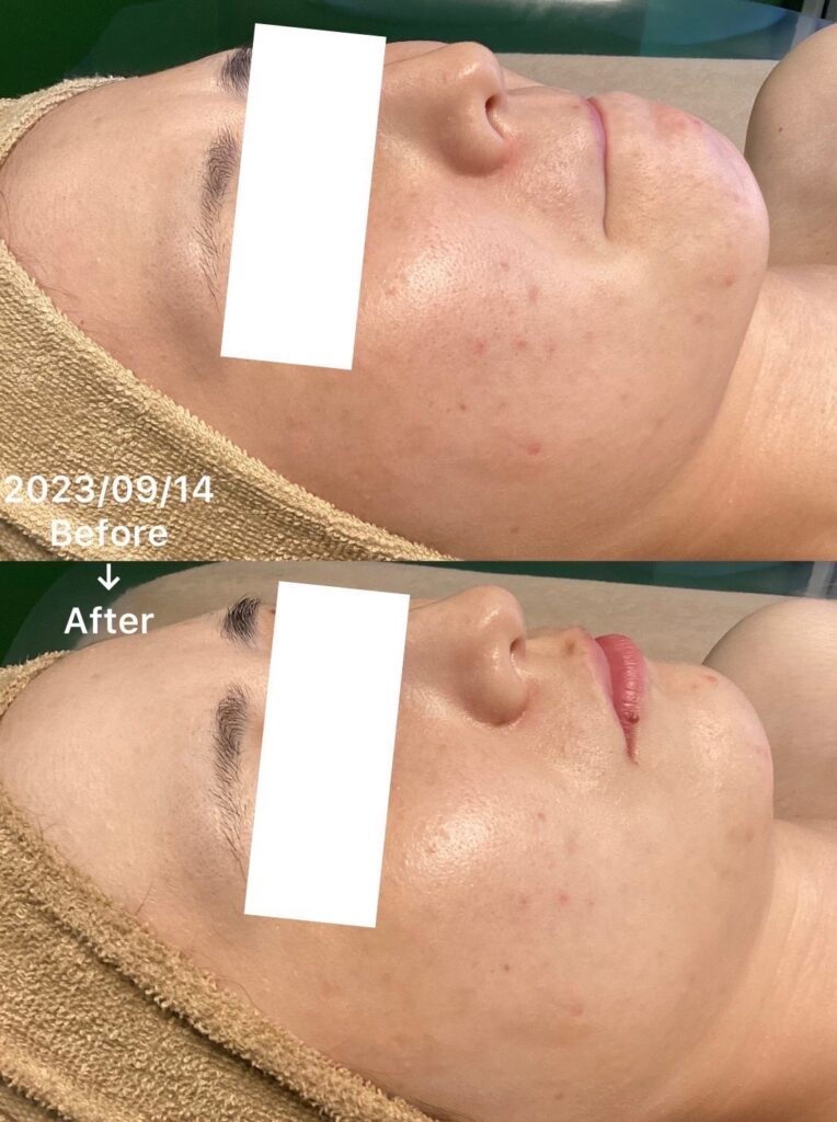 ハーブオフトリートメント 施術事例