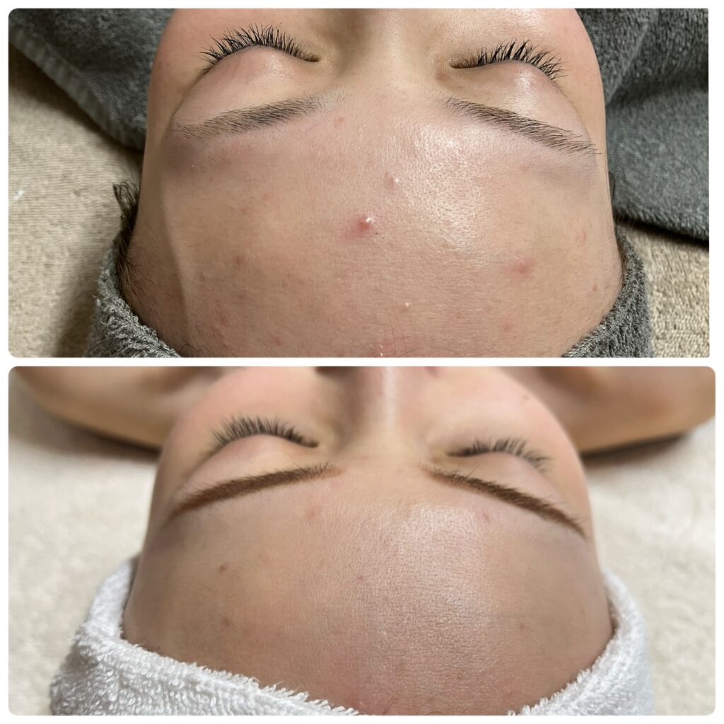 ハーブオフトリートメント 施術事例