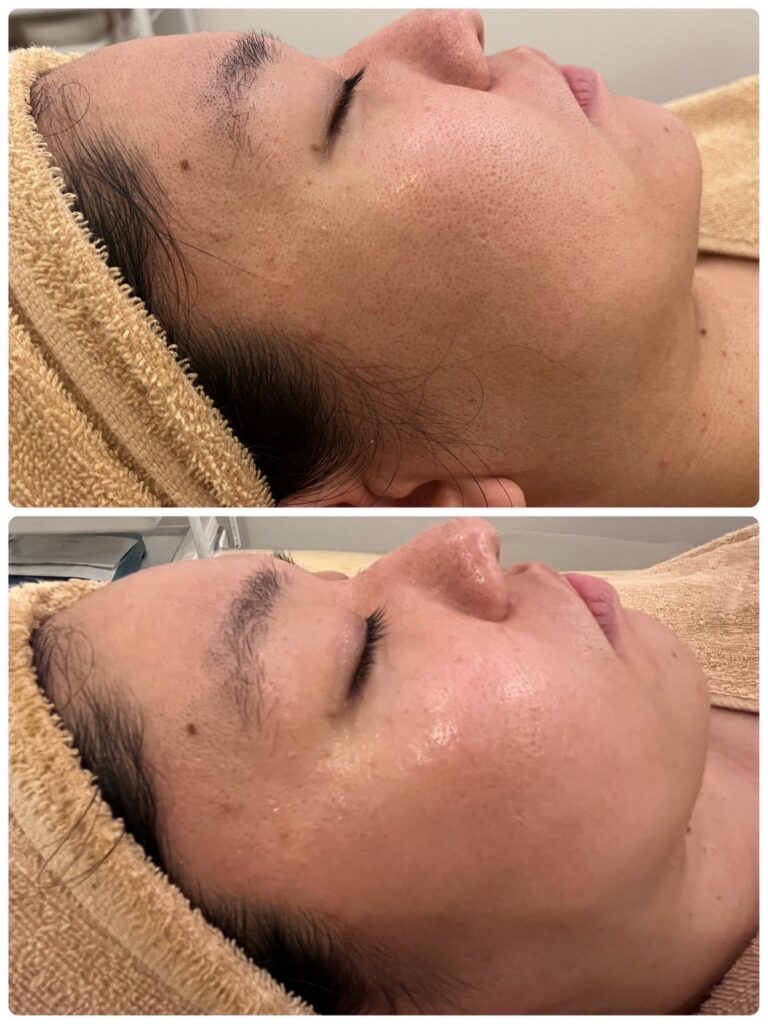 ハーブオフトリートメント 施術事例