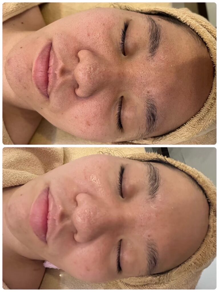 ハーブオフトリートメント 施術事例