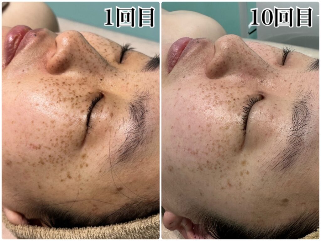 ハーブオフトリートメント 施術事例