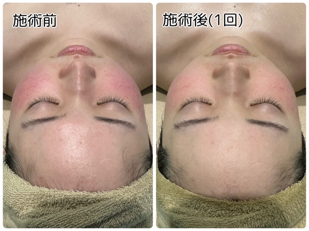 ハーブオフトリートメント 施術事例