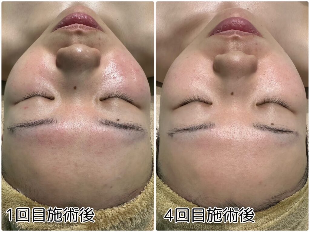 ハーブオフトリートメント 施術事例