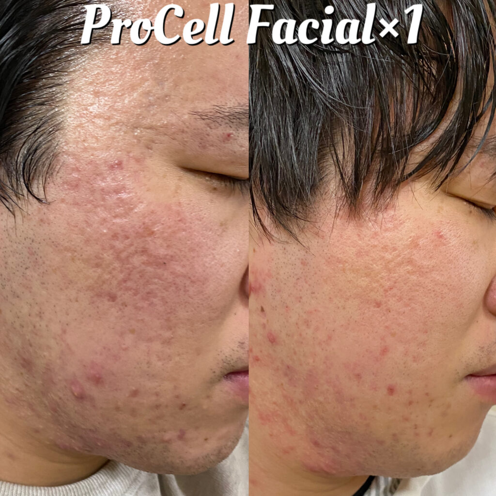 1回のプロセルセラピーズで、ざらつきと凹凸が改善