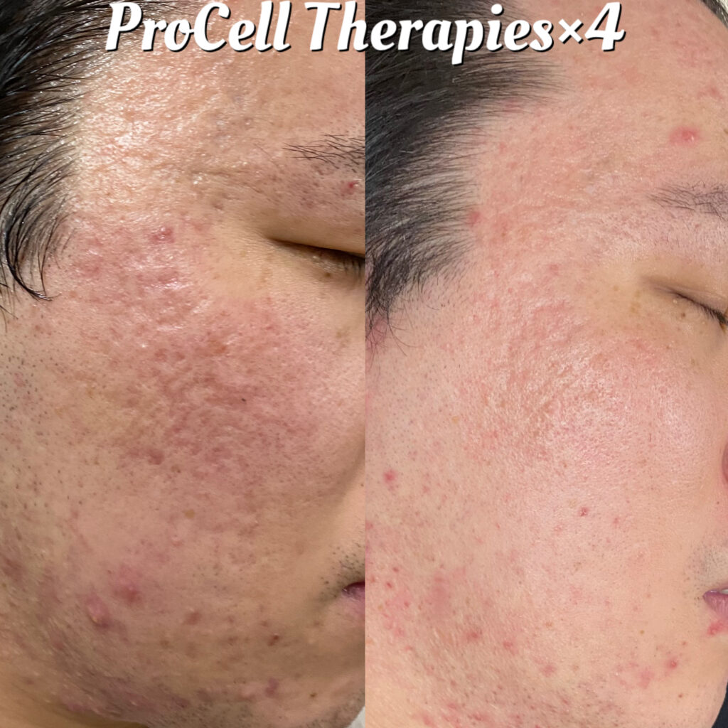 プロセルセラピーズ  施術事例