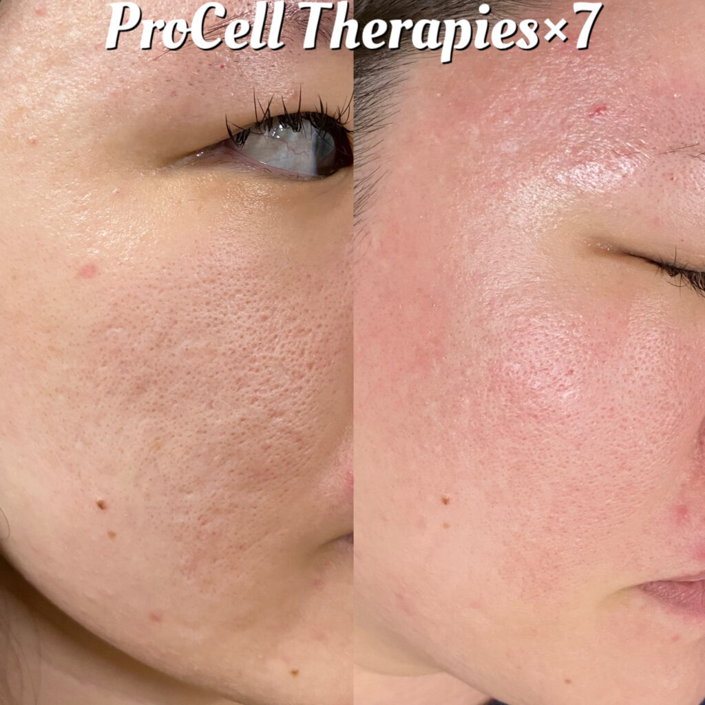 プロセルセラピーズ  施術事例