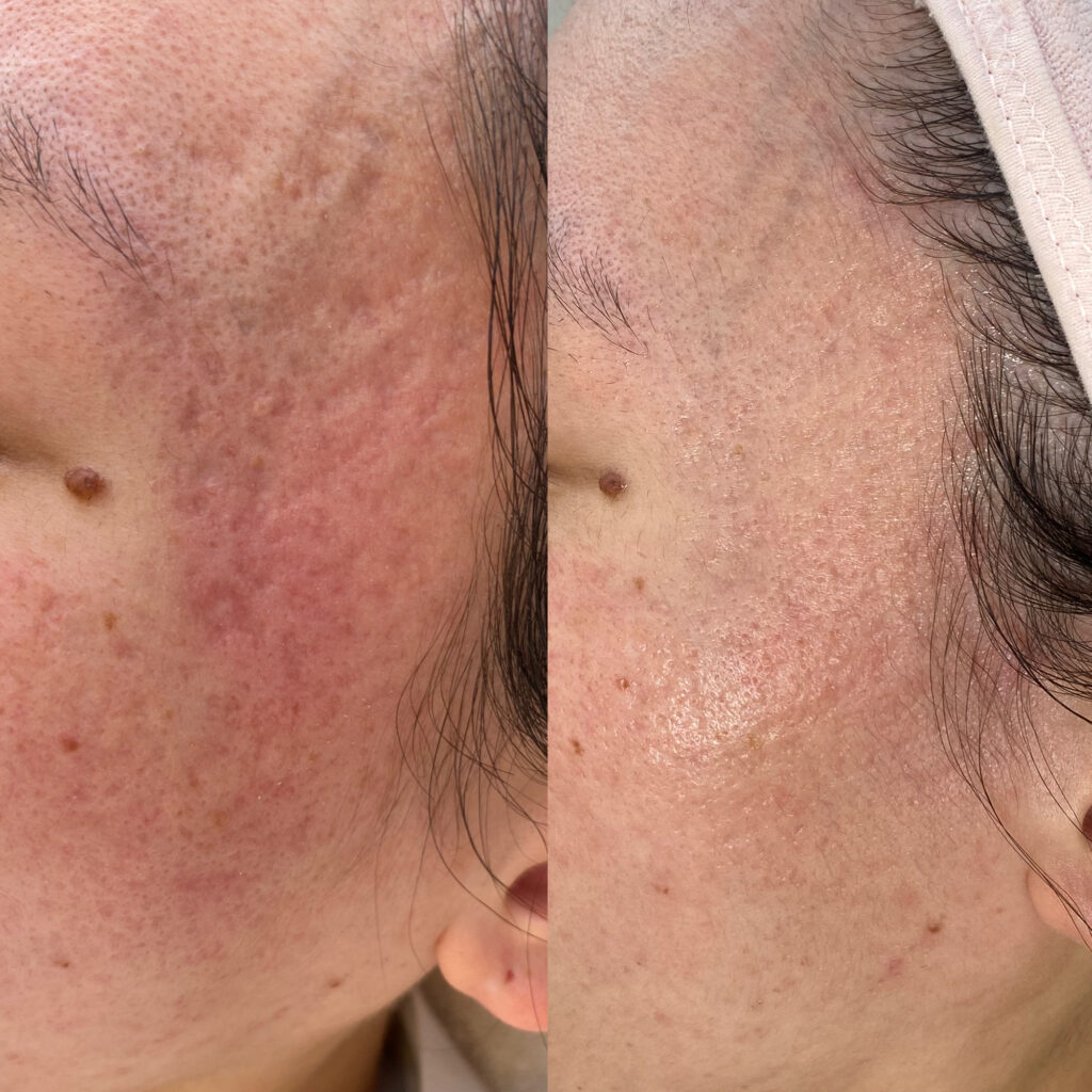 凹凸の印象が徐々にやわらぎ、肌全体の質感がなめらかに