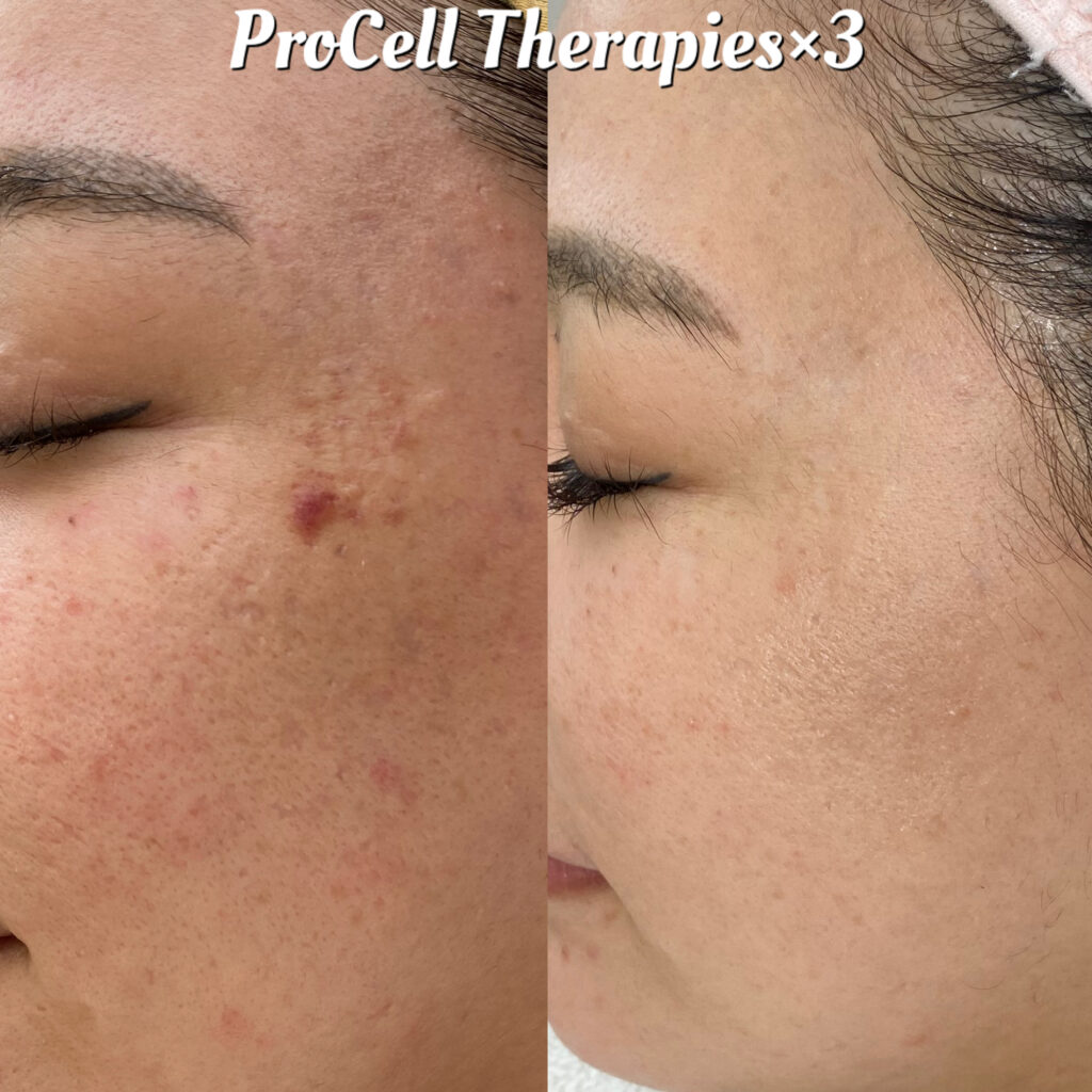 ニキビ跡・炎症