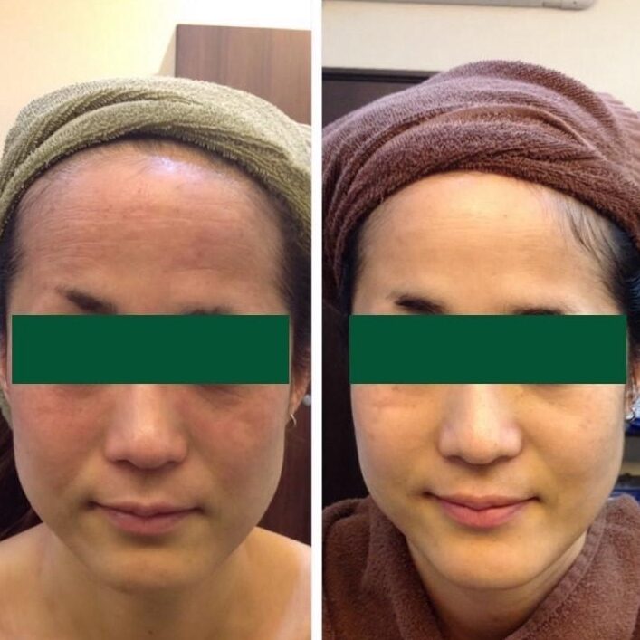 アトピー・色素沈着