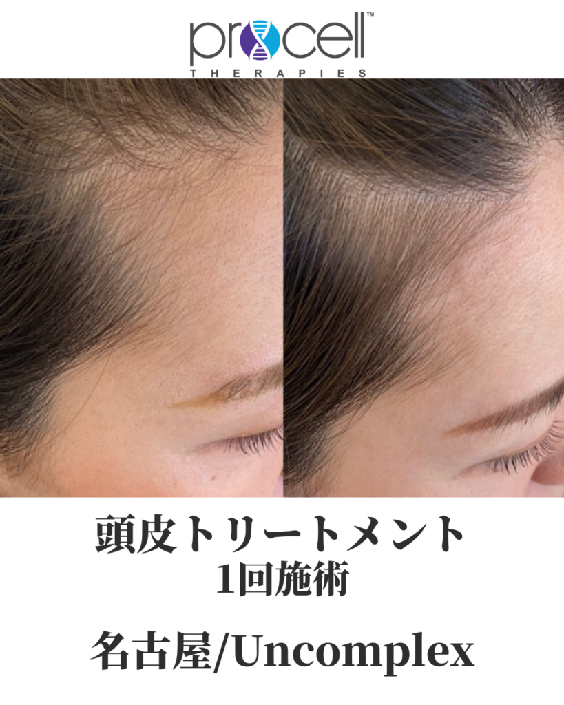 プロセルセラピーズ頭皮症例写真