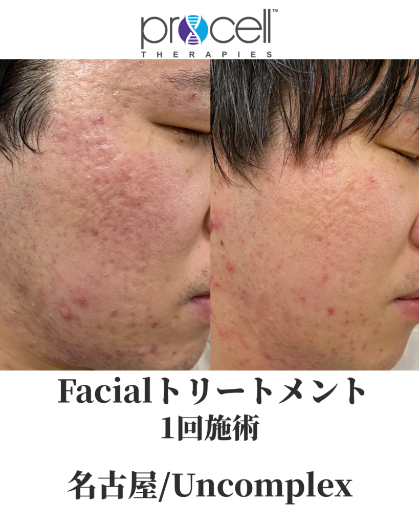 プロセルセラピーズ肌質改善症例写真
